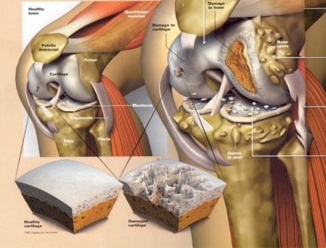 Arthritis Knee
