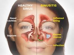 Sinus